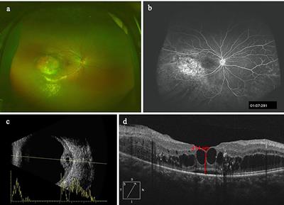 Cytokine Concentrations in Aqueous Humor of Eyes With Circumscribed Choroidal Hemangioma